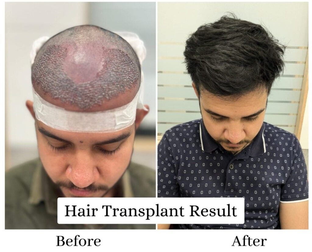 Hair transplant procedure showing significant hair growth.