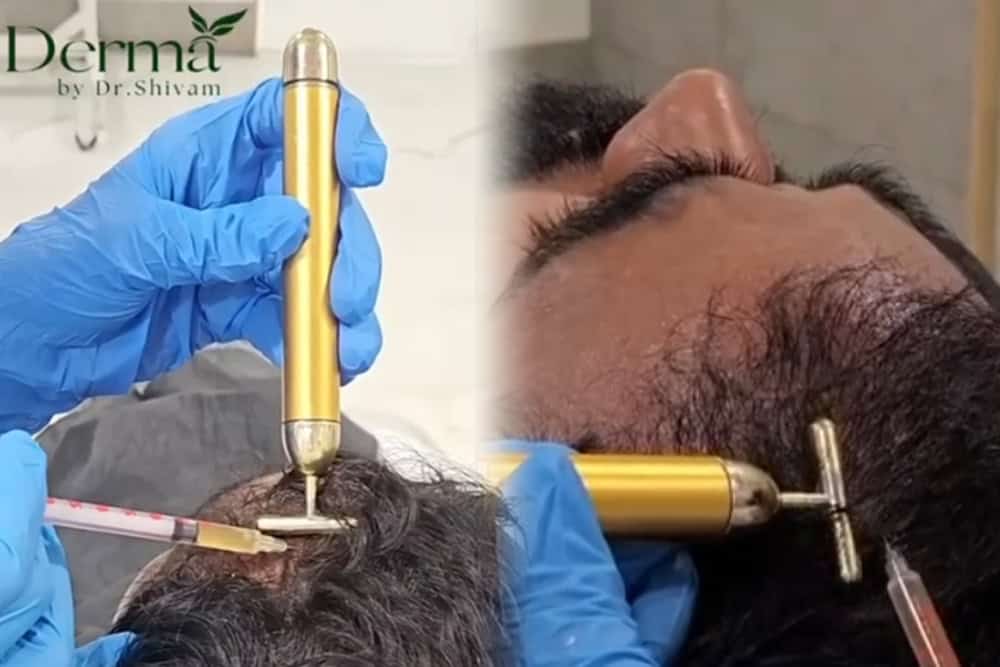 PRP Hair Treatment